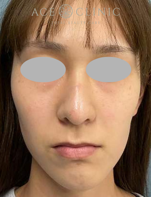 ルビーフラクショナル｜症例18｜20代女性｜術前｜エースクリニック大阪梅田HEPナビオ院