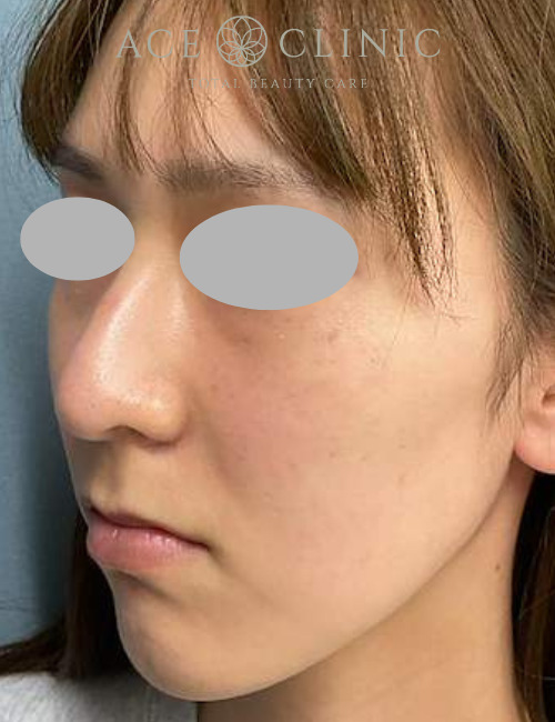 ルビーフラクショナル|症例18|20代女性|術前|エースクリニック大阪梅田HEPナビオ院