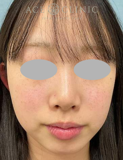 ルビーフラクショナル｜症例19｜10代女性｜術前｜エースクリニック大阪梅田HEPナビオ院