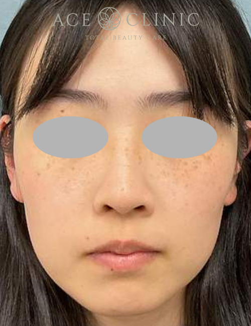 ルビーフラクショナル|症例20|20代女性|術後|エースクリニック大阪梅田HEPナビオ院