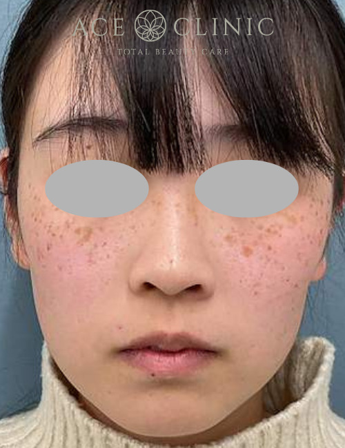 ルビーフラクショナル｜症例20｜20代女性｜術前｜エースクリニック大阪梅田HEPナビオ院