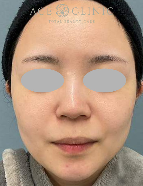 水光注射｜症例6｜30代女性｜術後｜エースクリニック大阪梅田HEPナビオ院