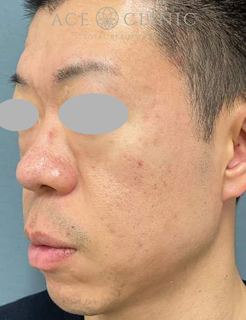 トライフィルプロ+ポテンツァ|症例2|30代男性|術後|エースクリニック大阪梅田HEPナビオ院