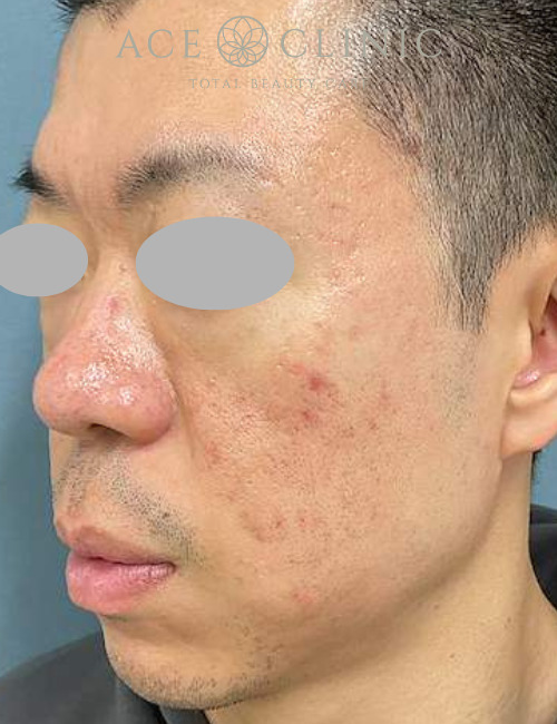 トライフィルプロ+ポテンツァ|症例2|30代男性|術前|エースクリニック大阪梅田HEPナビオ院