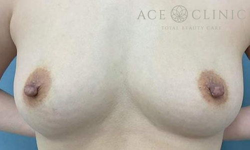 乳頭縮小術｜症例62｜50代女性｜術前｜エースクリニック大阪梅田HEPナビオ院