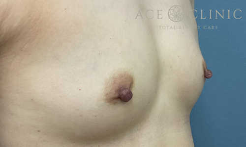 乳頭縮小術｜症例64｜50代女性｜術前｜エースクリニック大阪梅田HEPナビオ院