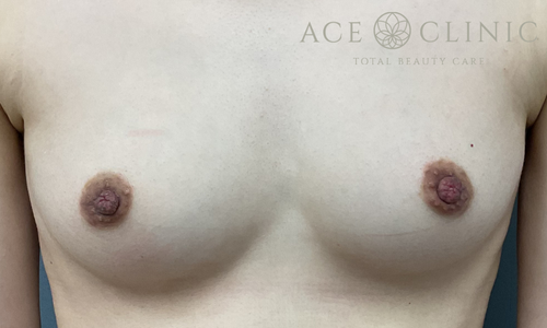 乳頭縮小術｜症例67｜30代女性｜術後｜エースクリニック大阪梅田HEPナビオ院