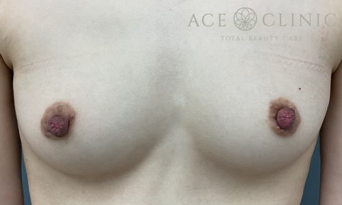 乳頭縮小術｜症例67｜30代女性｜術前｜エースクリニック大阪梅田HEPナビオ院